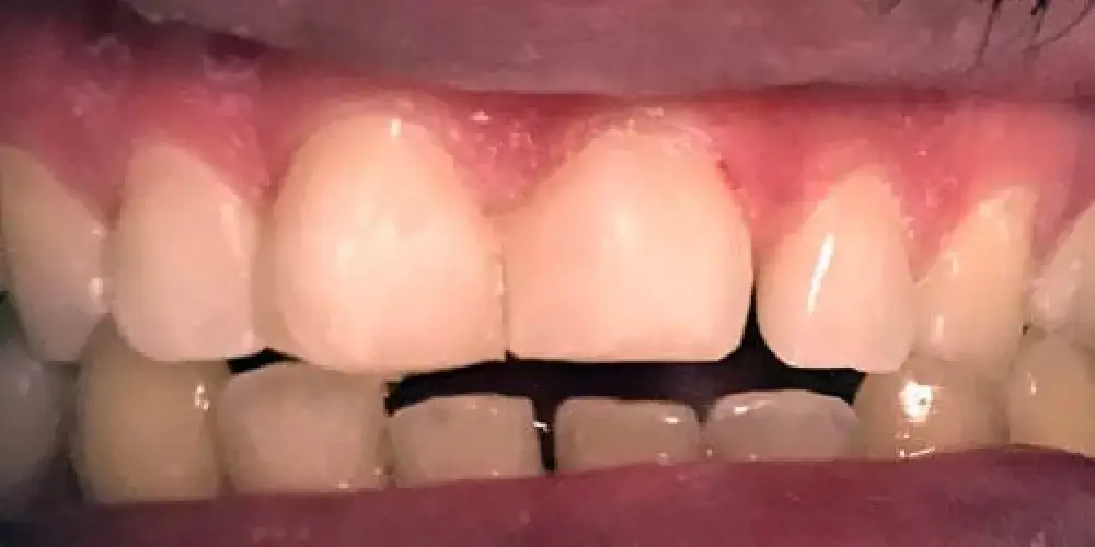 A close-up of a person's upper and lower teeth with a gap between the front teeth.