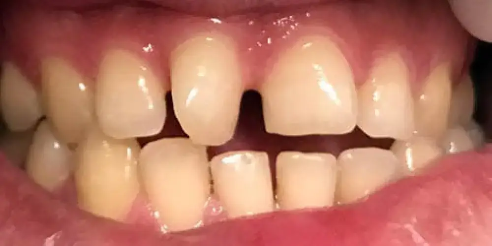 Close-up of a person's upper front teeth with a noticeable gap between the two central teeth.