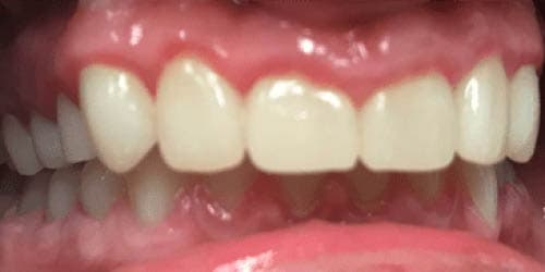 After Dental Procedure